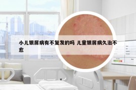 小兒銀屑病有不復(fù)發(fā)的嗎 兒童銀屑病久治不愈