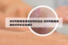 如何判斷銀屑病有好轉(zhuǎn)的征兆 如何判斷銀屑病有好轉(zhuǎn)的征兆圖片