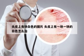頭皮上有塊白色的圖片 頭皮上有一塊一塊的白色怎么治