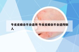 牛皮皮癬會(huì)不會(huì)遺傳 牛皮皮癬會(huì)不會(huì)遺傳別人