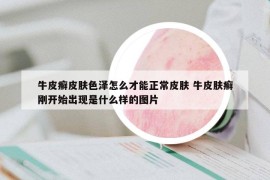 牛皮癬皮膚色澤怎么才能正常皮膚 牛皮膚癬剛開始出現(xiàn)是什么樣的圖片