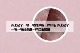 身上起了一塊一塊的像癬一樣紅色 身上起了一塊一塊的像癬一樣紅色圓圈