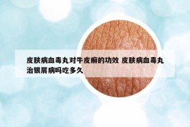 皮膚病血毒丸對牛皮癬的功效 皮膚病血毒丸治銀屑病嗎吃多久