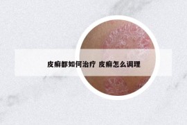皮癬都如何治療 皮癬怎么調(diào)理