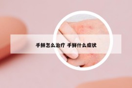 手鮮怎么治療 手鮮什么癥狀