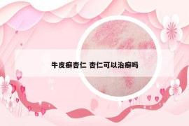 牛皮癬杏仁 杏仁可以治癬嗎