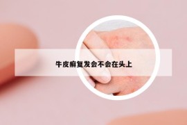 牛皮癬復(fù)發(fā)會不會在頭上