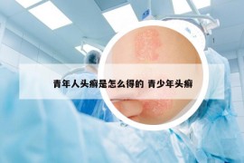 青年人頭癬是怎么得的 青少年頭癬
