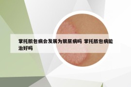 掌托膿包病會(huì)發(fā)展為銀屑病嗎 掌托膿包病能治好嗎