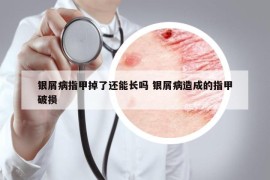 銀屑病指甲掉了還能長嗎 銀屑病造成的指甲破損