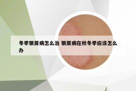 冬季銀屑病怎么治 銀屑病在秋冬季應(yīng)該怎么辦