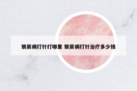 銀屑病打針打哪里 銀屑病打針治療多少錢(qián)