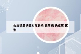 頭皮銀屑病是對(duì)稱長(zhǎng)嗎 銀屑病 頭皮屑 區(qū)別