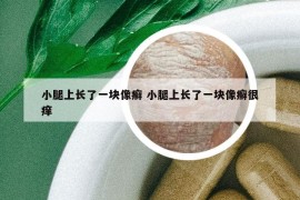 小腿上長了一塊像癬 小腿上長了一塊像癬很癢