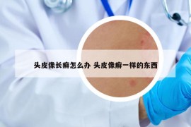 頭皮像長(zhǎng)癬怎么辦 頭皮像癬一樣的東西