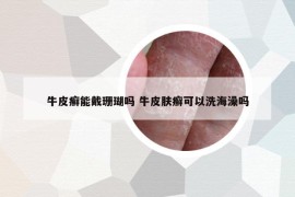 牛皮癬能戴珊瑚嗎 牛皮膚癬可以洗海澡嗎