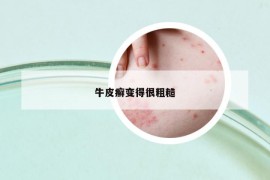 牛皮癬變得很粗糙