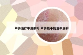 蘆薈治療牛皮癬嗎 蘆薈能不能治牛皮癬