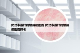 武漢市最好的銀屑病醫(yī)院 武漢市最好的銀屑病醫(yī)院排名