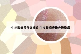 牛皮膚癬是傳染病嗎 牛皮膚癬癥狀會(huì)傳染嗎