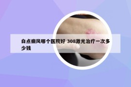 白點(diǎn)癲風(fēng)哪個(gè)醫(yī)院好 308激光治療一次多少錢(qián)