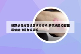 新冠病毒疫苗銀屑病能打嗎 新冠病毒疫苗銀屑病能打嗎有效果嗎