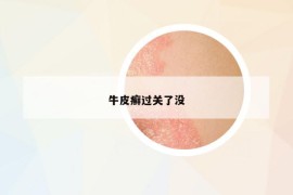 牛皮癬過關(guān)了沒