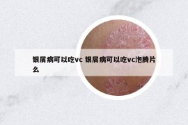 銀屑病可以吃vc 銀屑病可以吃vc泡騰片么