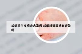 戒煙后牛皮癬會(huì)大發(fā)嗎 戒煙對銀屑病有好處嗎