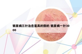 銀屑病三針治愈是真的假的 銀屑病一針3000