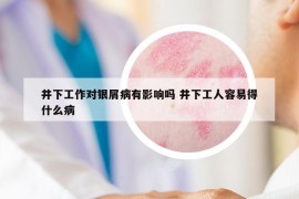 井下工作對銀屑病有影響嗎 井下工人容易得什么病