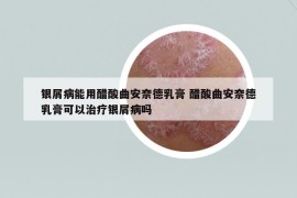 銀屑病能用醋酸曲安奈德乳膏 醋酸曲安奈德乳膏可以治療銀屑病嗎