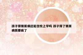 孩子得銀屑病還能住校上學(xué)嗎 孩子得了銀屑病我要瘋了
