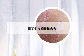 得了牛皮癬開(kāi)銷(xiāo)太大