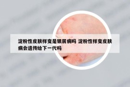 淀粉性皮膚樣變是銀屑病嗎 淀粉性樣變皮膚病會遺傳給下一代嗎