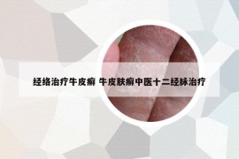 經(jīng)絡(luò)治療牛皮癬 牛皮膚癬中醫(yī)十二經(jīng)脈治療
