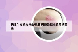 天津牛皮癬治療去哪里 天津最權(quán)威銀屑病醫(yī)院