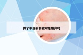 得了牛皮癬會(huì)被對(duì)象嫌棄嗎