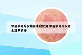 銀屑病光療儀能否家庭使用 銀屑病光療儀什么牌子的好