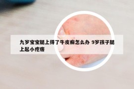 九歲寶寶腿上得了牛皮癬怎么辦 9歲孩子腿上起小疙瘩