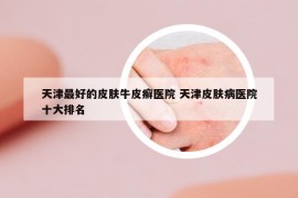 天津最好的皮膚牛皮癬醫(yī)院 天津皮膚病醫(yī)院十大排名