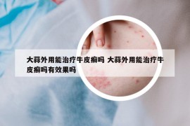 大蒜外用能治療牛皮癬嗎 大蒜外用能治療牛皮癬嗎有效果嗎