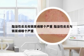 脂溢性皮炎和銀屑病那個(gè)嚴(yán)重 脂溢性皮炎與銀屑病哪個(gè)嚴(yán)重