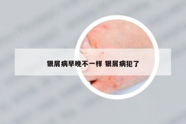 銀屑病早晚不一樣 銀屑病犯了