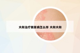 大和治療銀屑病怎么樣 大和大和