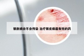銀削病會不會傳染 治療銀皮癬最有效的藥