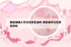 銀屑病病人可以吃葵花油嗎 銀屑病可以吃葵花籽嗎
