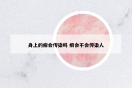 身上的癬會傳染嗎 癬會不會傳染人