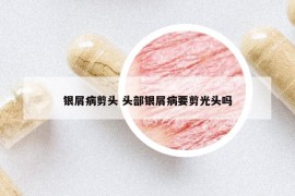 銀屑病剪頭 頭部銀屑病要剪光頭嗎