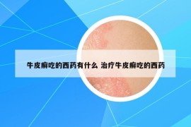 牛皮癬吃的西藥有什么 治療牛皮癬吃的西藥